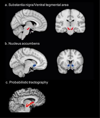 Increased meso-striatal connectivity mediates trait impulsivity in FTO variant carriers